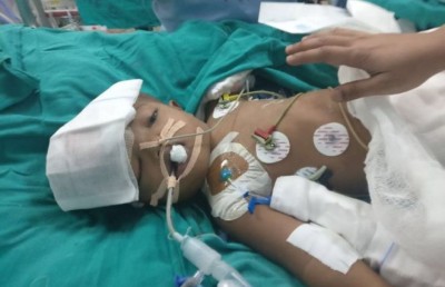 ބޮލުން ގުޅިފައިވާ ދެ ކުދިން އިންޑިއާގެ ޑޮކްޓަރުން ވަކިކޮށްފި