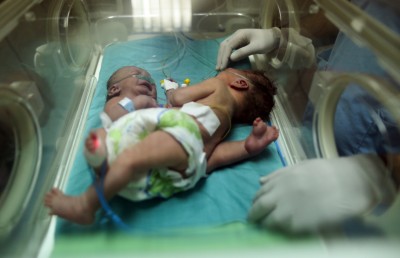 އެއްހަށިގަނޑުން ގުޅިފައިވާ ގާޒާގެ ދެ ކުދިންގެ އޮޕަރޭޝަން ކާމިޔާބު