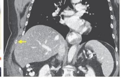 މާ ގަދަޔަށް ކެއްސުމުން މޭކަށިގަނޑެއް ބިނދިއްޖެ