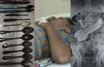 މީހެއްގެ ބަނޑުގައި ވަޅި އާއި ސަމުސަލާއި ކަށިގަނޑު