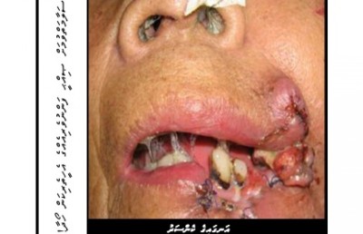 އިންޒާރުގެ މަންޒަރު ނުޖަހައި ދުންފަތުގެ ބާވަތްތައް އެތެރެކުރުން މަނާކޮށްފި