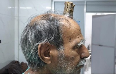 އަނިޔާއެއްގެ ސަބަބުން މީހެއްގެ ބޮލުގައި ފެޅި "ދަޅެއް" ނަގައިފި