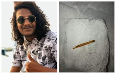 އަހަރެއް ފަހުން އޮޕަރޭޝަންކޮށް ބެލިއިރު އަތުގައި އިލޮށިކޮޅެއް!