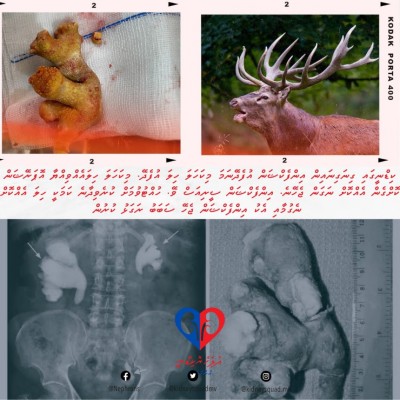 ކިޑްނީ ތޮރުފައިގެން ހިލަ ނެގުމުގެ ފުރަތަމަ އޮޕަރޭޝަން އައިޖީއެމްއެޗުގައި ކޮށްފި