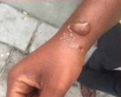 ބުޅަލުުގެ ނަޖިހުންނާއި ވެލީގެ ސަބަބުން ބައްޔެއް ޖެހޭތީ ސަމާލުވާން އިލްތިމާސްކޮށްފި