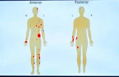 ނަޝީދުުގެ ފުރާނަ ސަލާމަތްކުރަން އޭޑީކޭ ޑޮކްޓަރުން ބޮޑު ގުރުބާނީއެއް