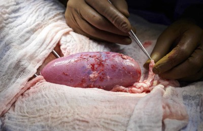 އިންސާނެއްގެ ހަށިގަނޑުގައި އޫރެއްގެ ކިޑްނީ އިންދައިފި