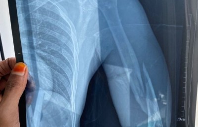 ލަވަކިޔުންތެރިޔާ ފަތޯގެ އަތް ބިންދާލުމުން އޮޕަރޭޝަން ނުކުރެވި ހޮސްޕިޓަލުގައި