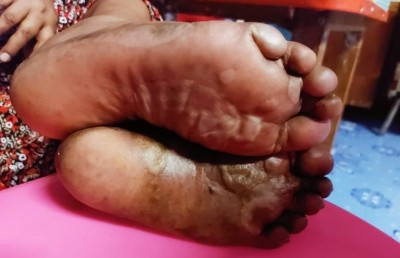 ހަ އަހަރުގައި ޕޯލިއޯ ޖެހި ނުކުޅެދޭ ހާލުގައި، ހަކުރު ބަލީގައި 20 އަހަރު