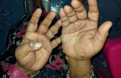 ހަ އަހަރުގައި ޕޯލިއޯ ޖެހި ނުކުޅެދޭ ހާލުގައި، ހަކުރު ބަލީގައި 20 އަހަރު