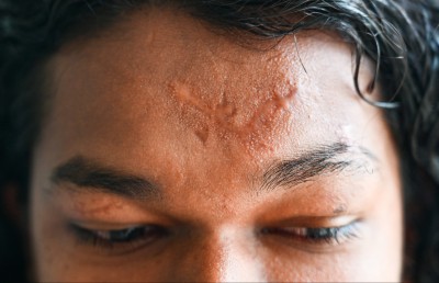 ފައި ބުރިކޮށްލުމުން ލިބުނު ހިތްވަރުގައި ހިނގަނީ މާ ބާރަށް