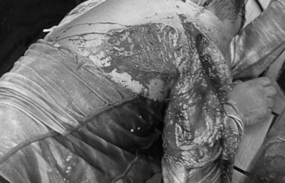 މިޔަރެއްގެ ހަމަލާގައި މީހެއްގެ ކޮނޑުހުޅު ނެއްޓި ބޮޑު ޒަހަމެއް