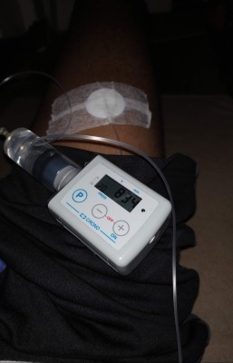 ތެލަސީމިއާއާ އެކު ގަދަ ކަނޑެއްގައި