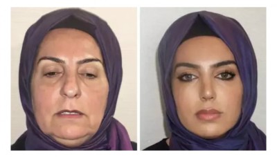 ޕްލާސްޓިކް ސާޖަރީން 68 އަހަރުގެ އަންހެނެއްގެ މޫނަށް ބޮޑެތި ބަދަލުތަކެއް