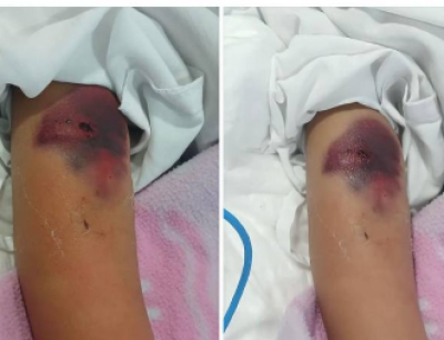 ތުއްތު ކުއްޖަކަށް ކުޅުދުއްފުށީ ހޮސްޕިޓަލުން އިހުމާލުވިކަމަށް ބުނާ މައްސަލަ ބަލަނީ