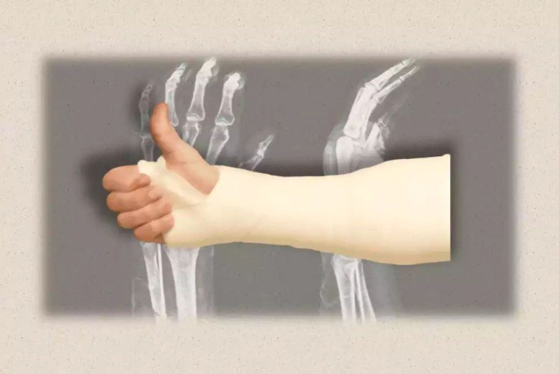 ކުއްޖެއްގެ އަތުގައި ރެނދެއް ލާފައިވާ ކަމަށް ބުނެ ޕްލާސްޓަރު އަޅަން އުޅުނީ އެހެން މީހެއްގެ އެކްސް ރޭ ބަލައިގެން!