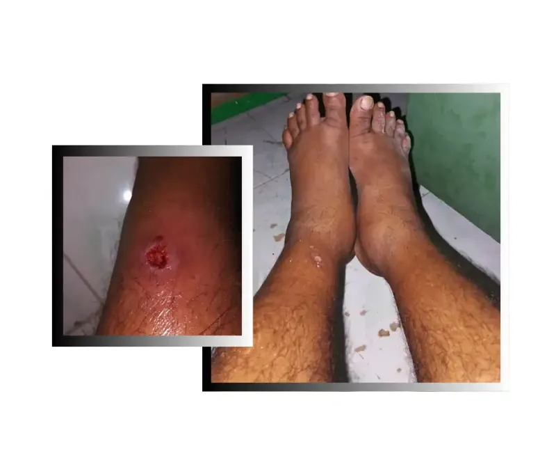 މާފުށީ ޖަލުގައި ހުރި ގައިދީއަކަށް ބޭސް ފަރުވާގެ ޚިދުމަތް ނުލިބި، އެމީހާގެ ފައި ފާރުވެ ގިރެނީ