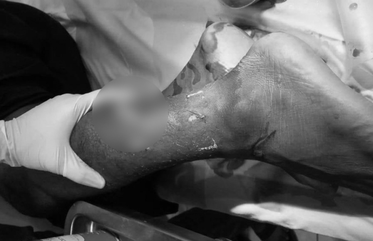 މިޔަރެއްގެ ހަމަލާގައި ޓޫރިސްޓަކު ޒަހަމްވެ، ފައިބުރިކޮށްލައިފި